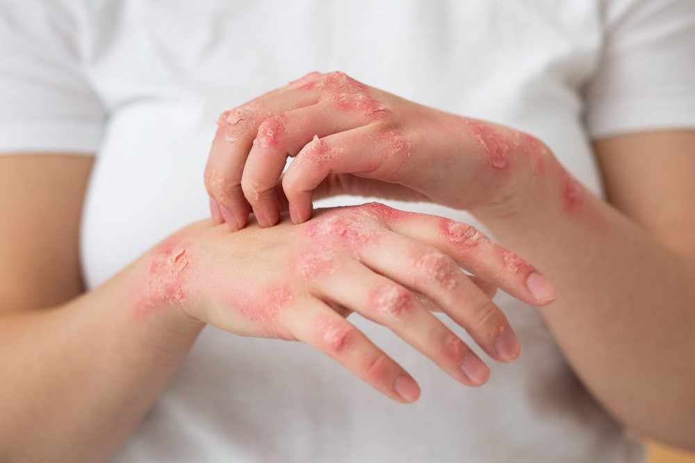 A young lady in a white t-shirt with hives rashes on both hands.